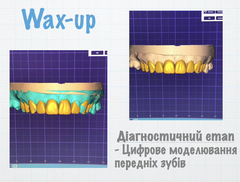 WAX-UP. Вокс-ап. Діагностичне моделювання зубів