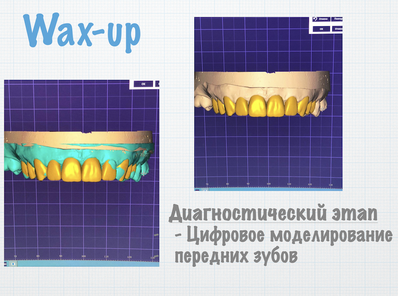 WAX-UP. Вокс-ап. Диагностическое моделирование зубов