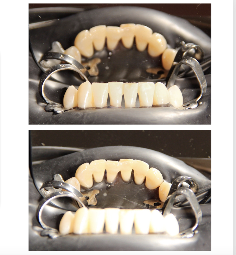 Шинуваннф зубів скловолоконною стрічкою при лікуванні пародонтиту 