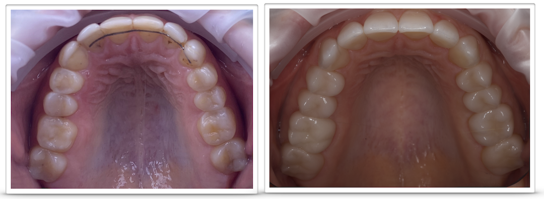 Установка керамічних коронок до та після. Протезування зубів